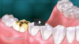 dental crown procedure video