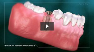 Dental Implant Procedure Video