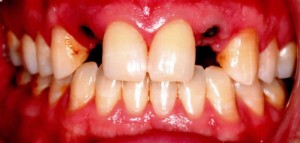 incisors missing dental implants needed