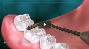 Composite Tooth Fillings Procedure Video