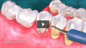 Dental Scaling and Root Planing Video